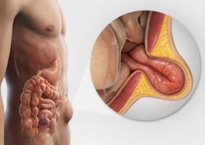 Our Services - Hernia Surgery - Dr. Nainesh Patel