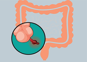 Top Appendix Gallbladder | Appendix Laparoscopic Surgery Cost