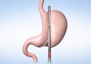 Advanced Laparoscopic bariatric surgery Surat obesity weight loss surgeon Dr Nainesh Patel