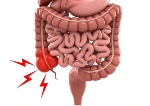 appendix surgery Surat appendicitis laparoscopic doctor Dr Nainesh Patel