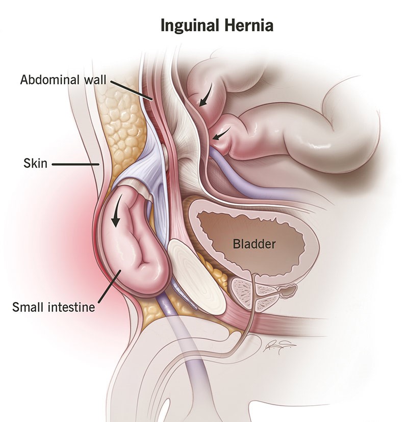 Best Laparoscopic Hernia Surgeon in Surat