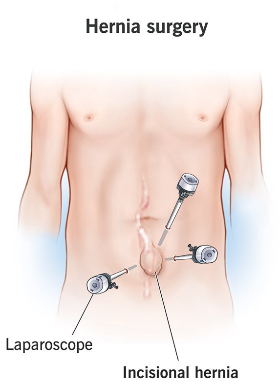 Laparoscopic Hernia Surgery
