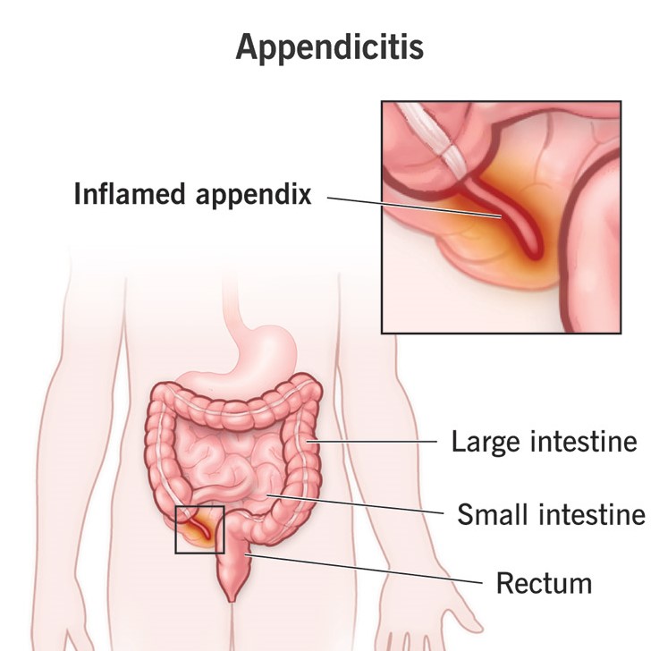 appendix surgery surat laparoscopic doctor