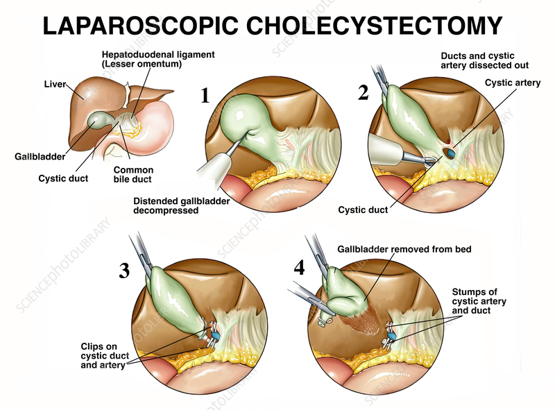 Laparoscopic Cholecystectomy most advanced and safe treatment for gallstones